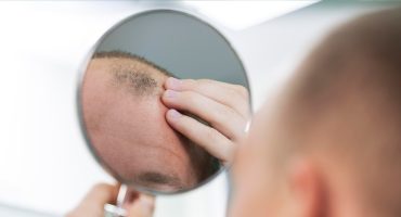 Alopesi Nedir?