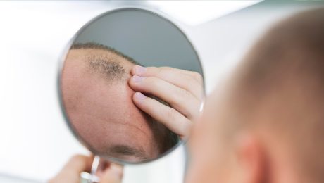 Alopesi Nedir?