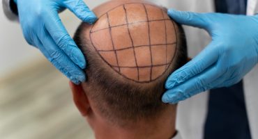 Hair Transplantation