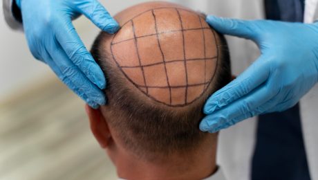 Hair Transplantation