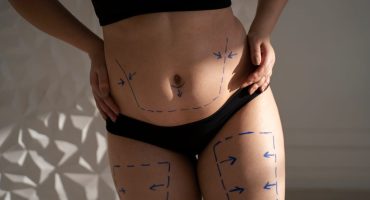 Liposuction Nedir?