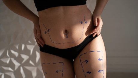 Liposuction Nedir?