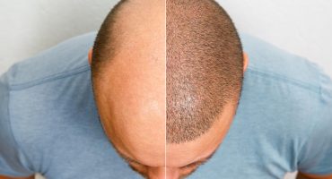 Hair Transplant