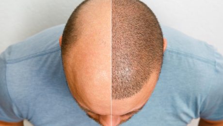 Hair Transplant